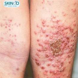 ảnh chụp màn hình cao trứng gà chữa viêm da cơ địa