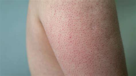 ảnh chụp màn hình da bị sần như nổi da gà