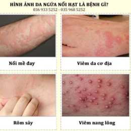 bệnh nổi da gà liên tục