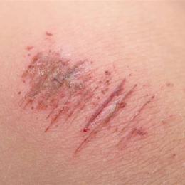 bị xước da có nên ăn thịt gà