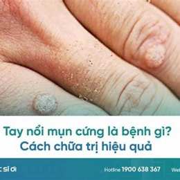 cách chữa da gà