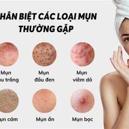 da bị nổi mụn như da gà