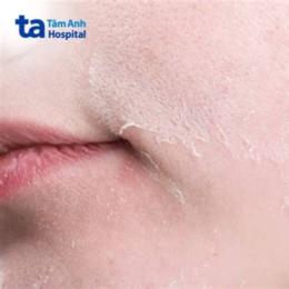 da bị sần sùi như da gà ngứa