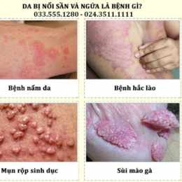 da chân bị sần sùi như da gà