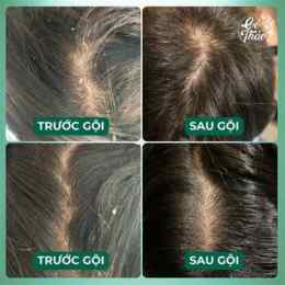 gàu da đầu nhẹ