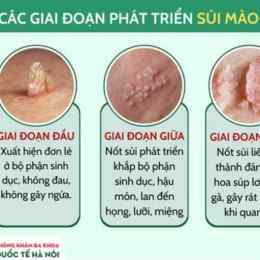 hình ảnh sùi mào gà trên da đầu