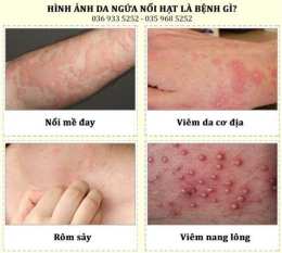 hướng dẫn sử dụng be bị nổi hạt nhỏ như da gà