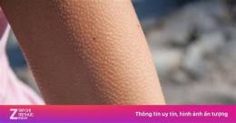 hướng dẫn sử dụng bệnh nổi da gà liên tục