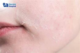 hướng dẫn sử dụng da bị sần sùi như da gà ngứa