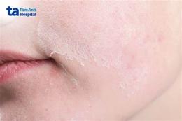 hướng dẫn sử dụng da bị sần sùi như nổi da gà
