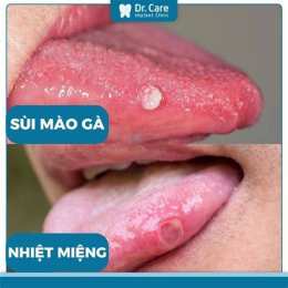hướng dẫn sử dụng da bị sùi mào gà