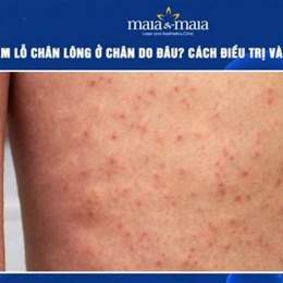 lỗ chân lông nổi như da gà