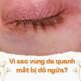 mắt láng da gà