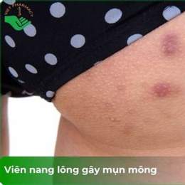 mông bị nổi da gà
