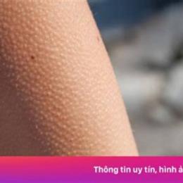 nổi da gà ớn lạnh