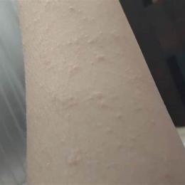 nổi hạt li ti như da gà