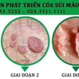 sùi mào gà ở da tay