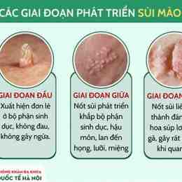 sùi mào gà trên da mặt
