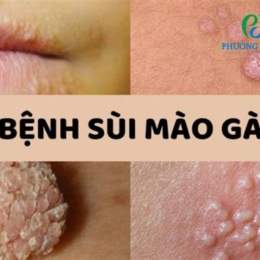 sùi màu gà bệnh viện da liễu