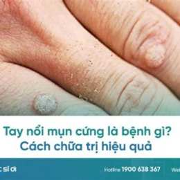 tay bị nổi da gà