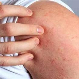 thường xuyên nổi da gà