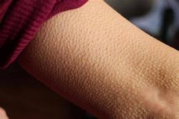 tính năng nổi bật cách trị da gà ở có