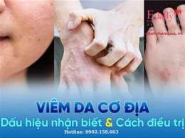 tính năng nổi bật cao trứng gà chữa viêm da cơ địa