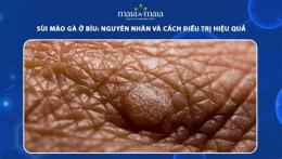 tính năng nổi bật da bị sùi mào gà