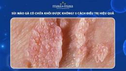 tính năng nổi bật đã có ai khỏi sùi mào gà chữa