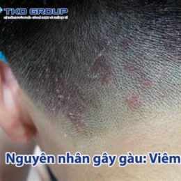 tình trạng da gà