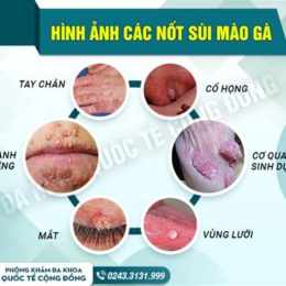 tối đã chữa khỏi sùi mào gà