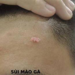 tôi đã khỏi sùi mào gà