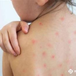 trẻ sốt mà nổi da gà
