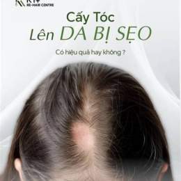 trứng chấy trên tóc gần da đầu