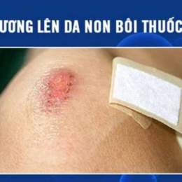 vết thương lên da non ăn gà được không